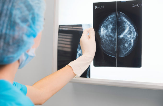 Tratamiento tras el cáncer de mama: tamoxifeno y exemestano